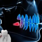 Impacted wisdom tooth causing pain