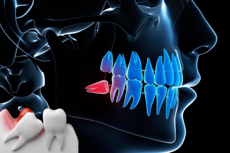 Impacted wisdom tooth causing pain